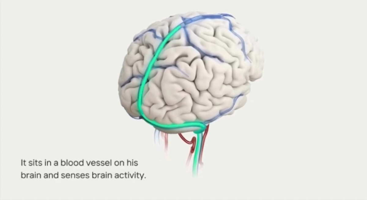 ⚡️О внедрении ChatGPT в мозг человека объявила компания Synchron 🧠
Synchron - занимается разработкой интерфейсов «мозг-компьютер».
Цель — помочь тяжелопарализованным пациентам снова общаться | Сетка — социальная сеть от hh.ru