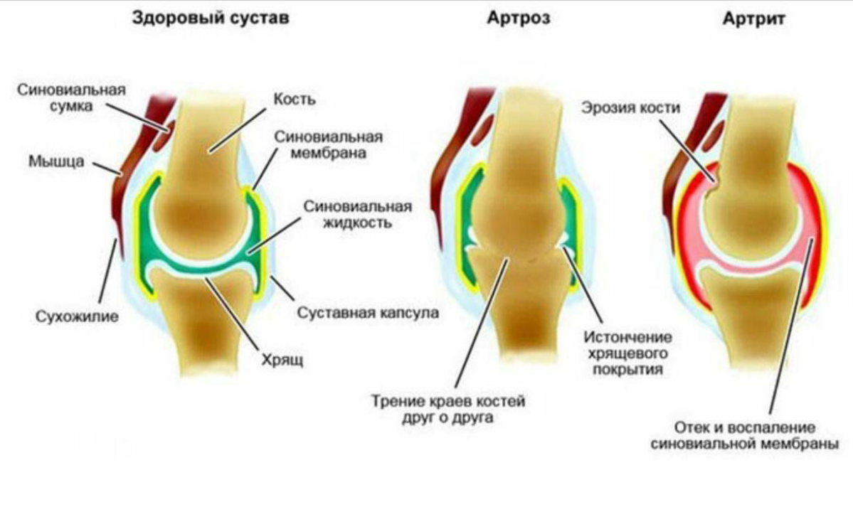 ОЗДОРОВЛЕНИЕ ,УКРЕПЛЕНИЕ ПРИ БОЛЕЗНЯХ СУСТАВОВ
❇️Олигопептид 25
❇️Анавиты (ОА, УЛЬТРА)
❇️Рипк
❇️Мезенов
❇️АЦС Богомольца
Массаж + питание+обильное питье!!! | Сетка — социальная сеть от hh.ru
