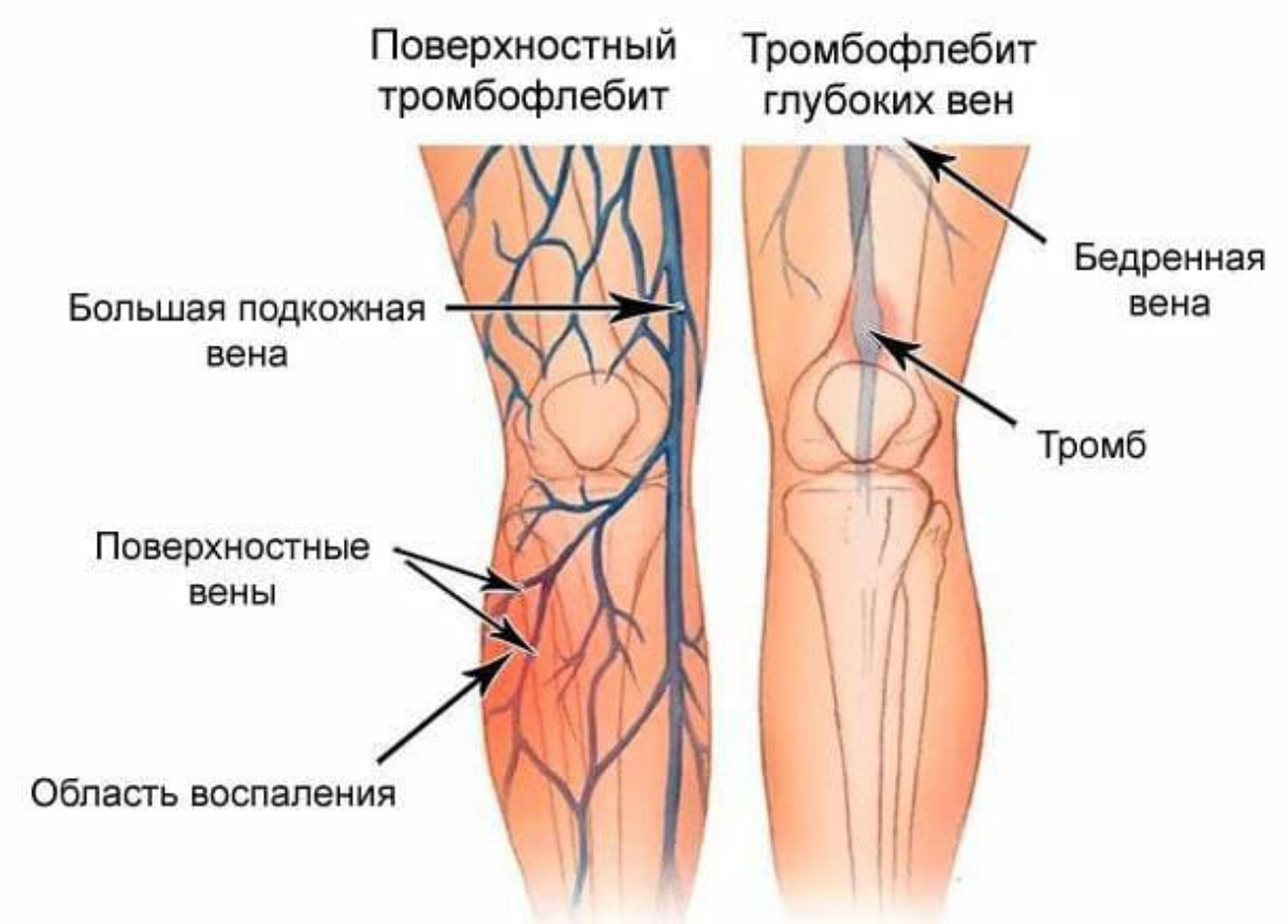 Что делать в случае возникновения тромбофлебита?
✅При возникновении осложнений, таких как тромбофлебит, важно сразу обратиться к врачу | Сетка — социальная сеть от hh.ru