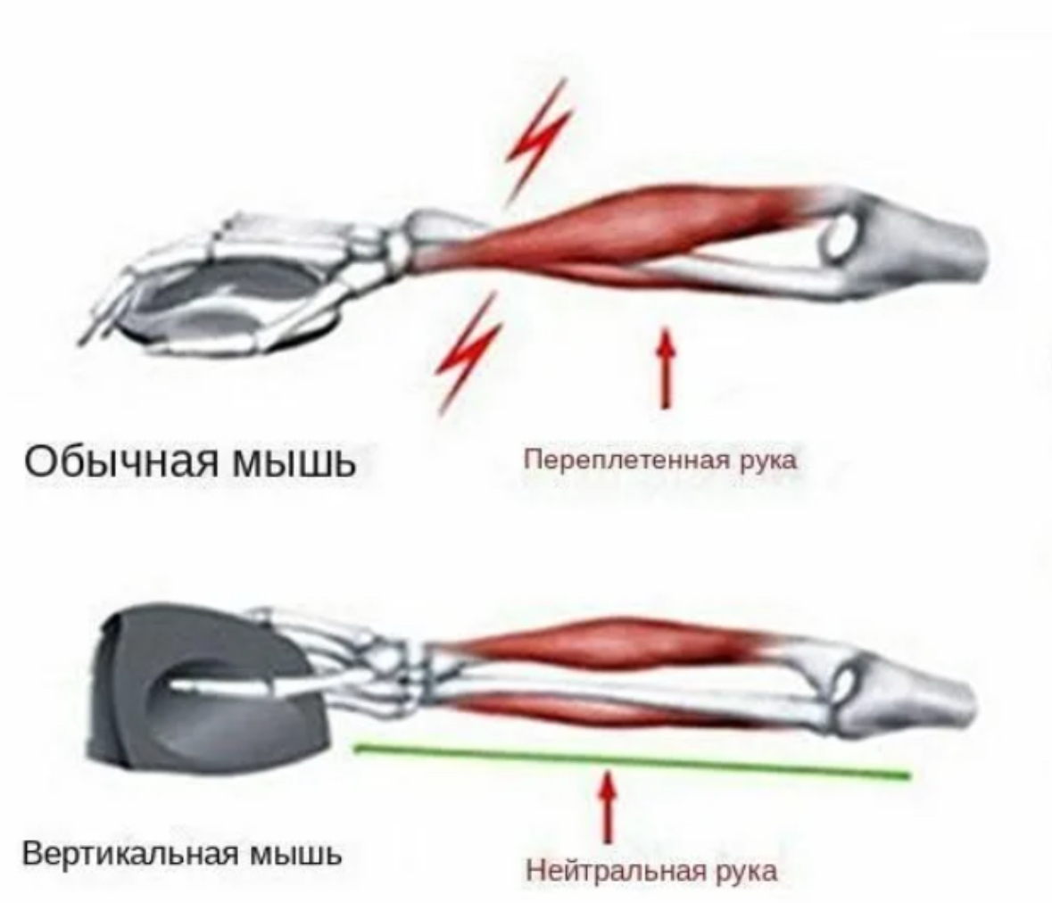 Что такое туннельный синдром? | Сетка — социальная сеть от hh.ru