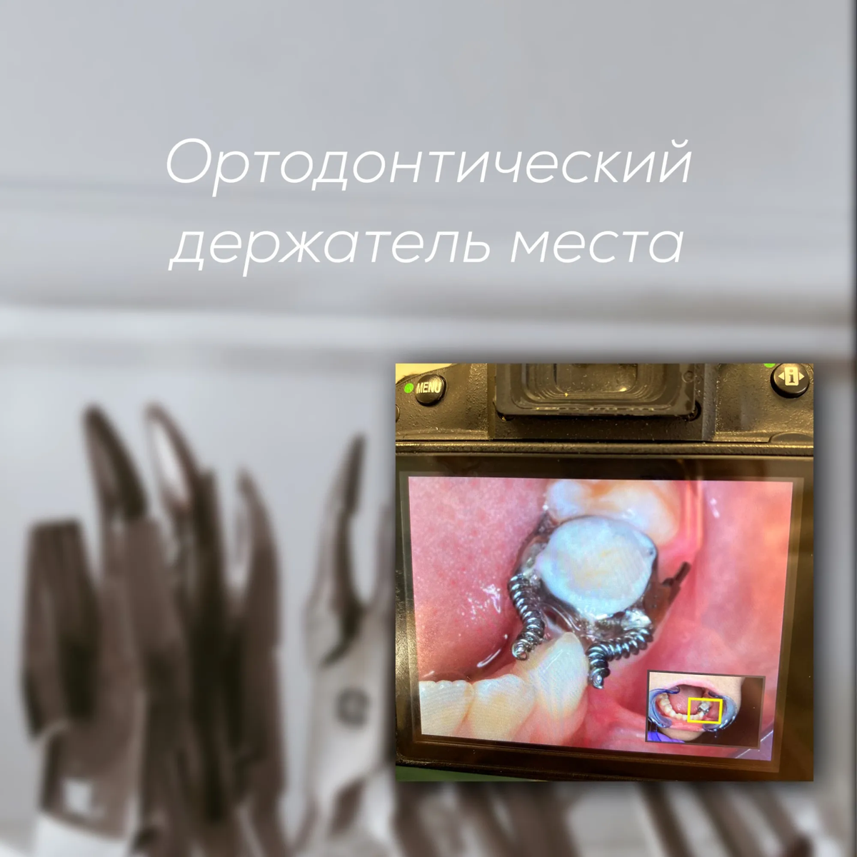 Большой секрет здоровья зубов -  крошечный держатель места | Сетка — социальная сеть от hh.ru