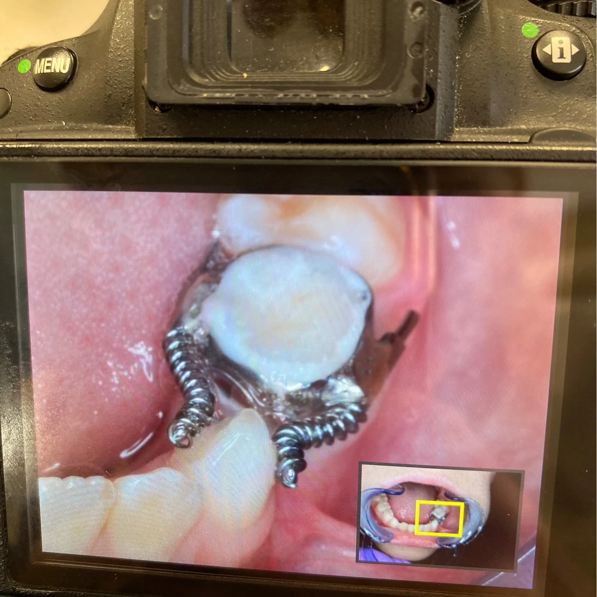 Большой секрет здоровья зубов -  крошечный держатель места | Сетка — социальная сеть от hh.ru