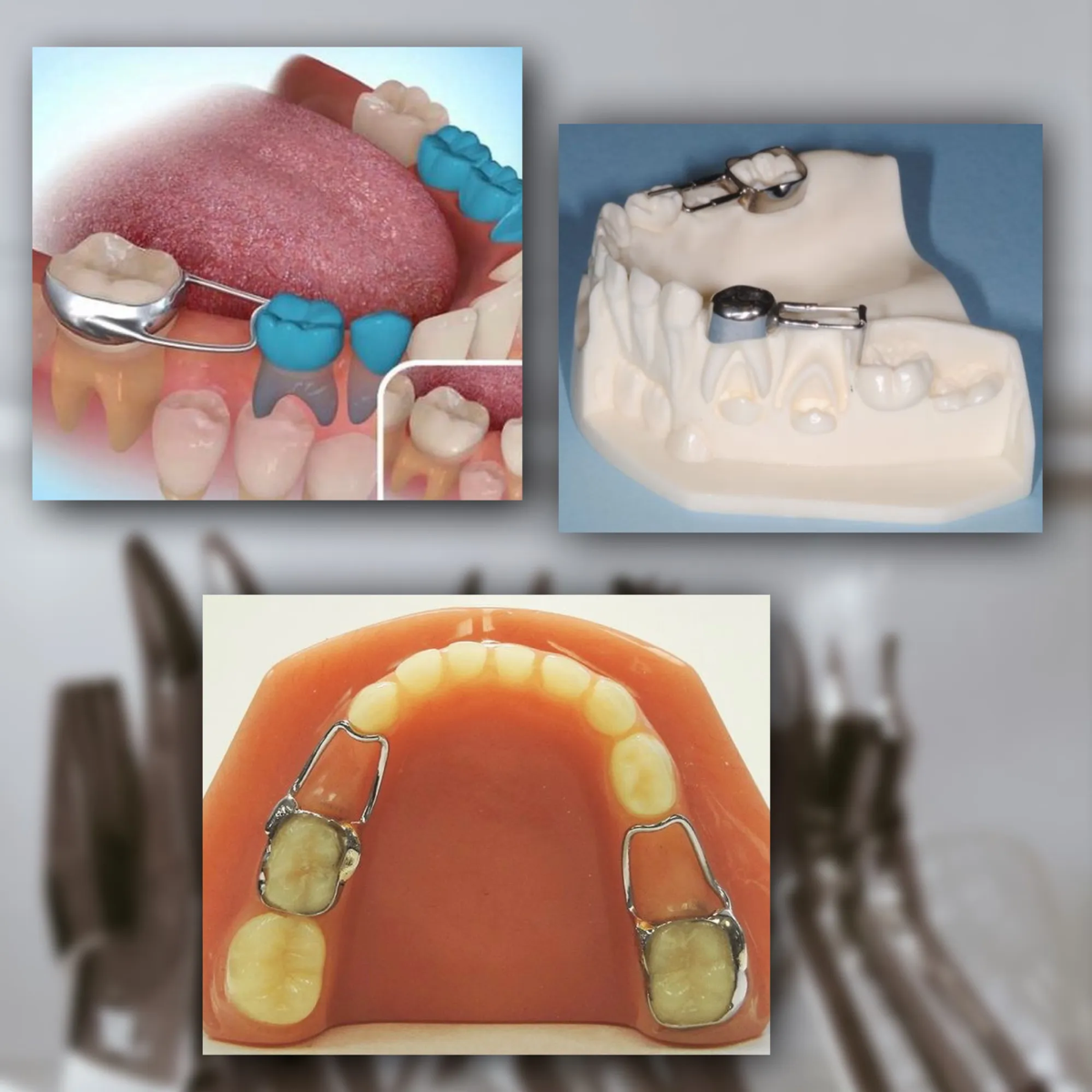 Большой секрет здоровья зубов -  крошечный держатель места | Сетка — социальная сеть от hh.ru