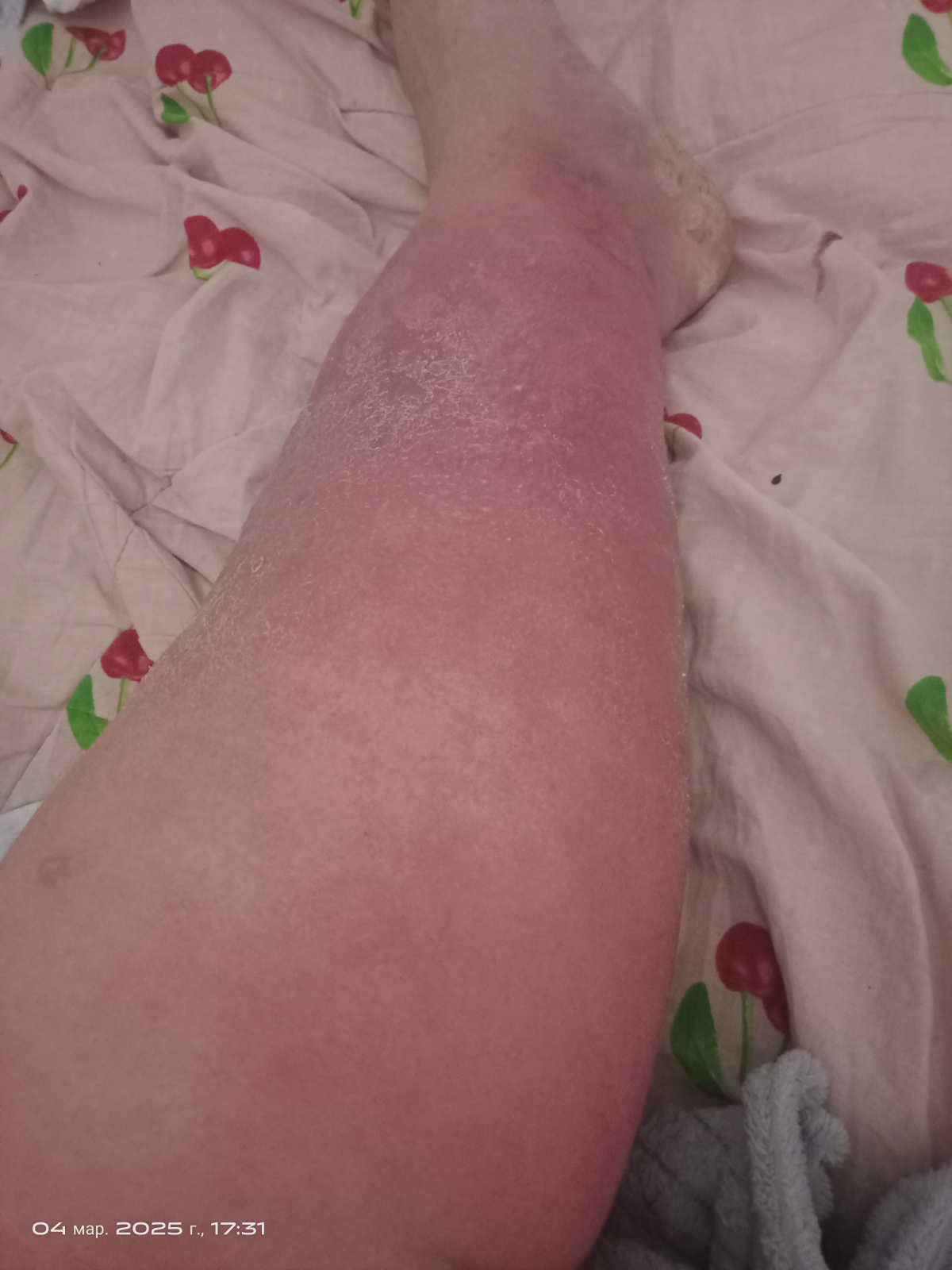 Уважаемые люди, у меня лимфостаз, каждый день пью лекарства, лечение не к чему не приводят, спрашивал, сказали что необходима операция, но в виду того что я не работаю, нигде деньги взять я не могу | Сетка — социальная сеть от hh.ru