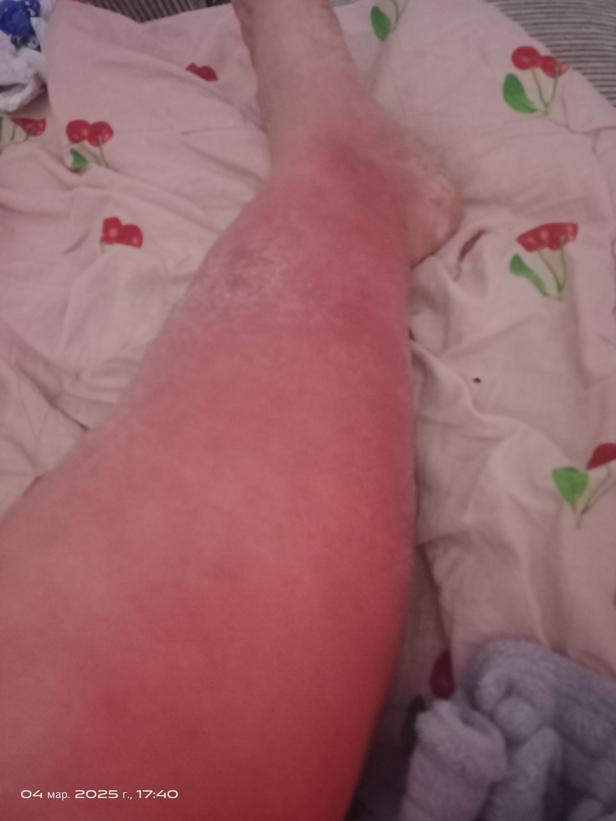 Уважаемые люди, у меня лимфостаз, каждый день пью лекарства, лечение не к чему не приводят, спрашивал, сказали что необходима операция, но в виду того что я не работаю, нигде деньги взять я не могу | Сетка — социальная сеть от hh.ru