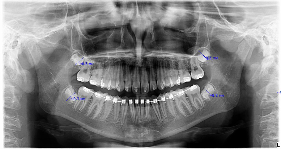 🦷 Зубы мудрости, или третьи моляры, последними появляются в зубном ряду. Процесс их развития и прорезывания сложный и индивидуальный, начинающийся задолго до того, как они появятся в полости рта | Сетка — социальная сеть от hh.ru