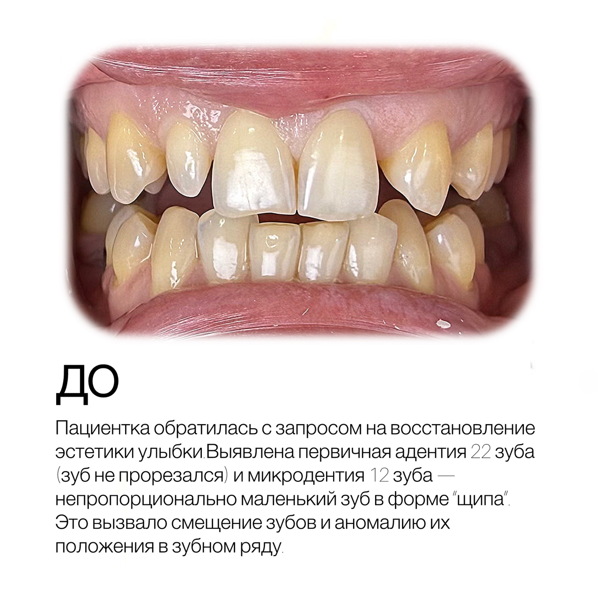 Когда один “неприметный” зуб меняет всё.
Пациентка обратилась к нам с запросом на восстановление эстетики.
На первый взгляд — просто недовольство улыбкой | Сетка — социальная сеть от hh.ru
