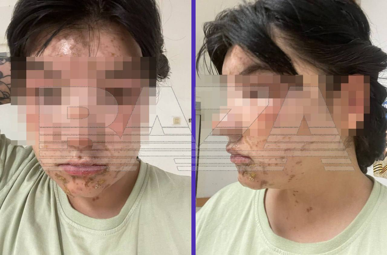 🆘 Сотруднице, заменявшей лаборанта на сельхозпредприятии в Ленобласти, прыснула серная кислота в лицо. Вот что бывает, когда сотрудникам дают слишком много задач | Сетка — социальная сеть от hh.ru