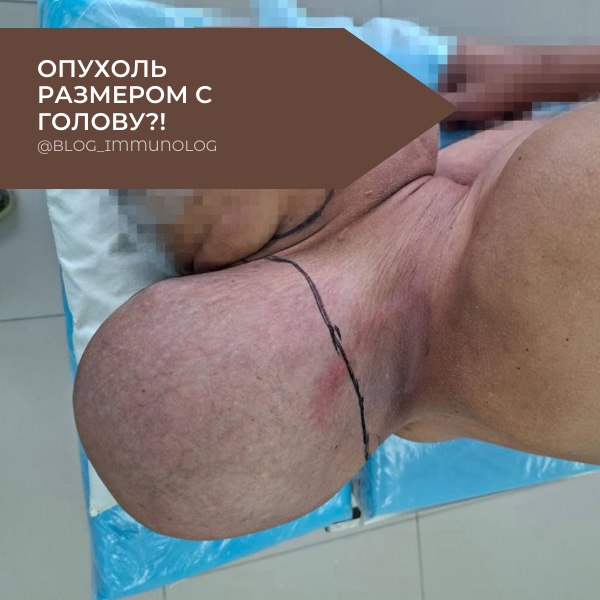 😱 ОПУХОЛЬ РАЗМЕРОМ С ГОЛОВУ?! 🤯 65-летний кировчанин 16 ЛЕТ игнорировал растущую липому!
Друзья, сегодня история, которая заставит вас пересмотреть отношение к своему здоровью! Представьте себе: опухо... | Сетка — социальная сеть от hh.ru