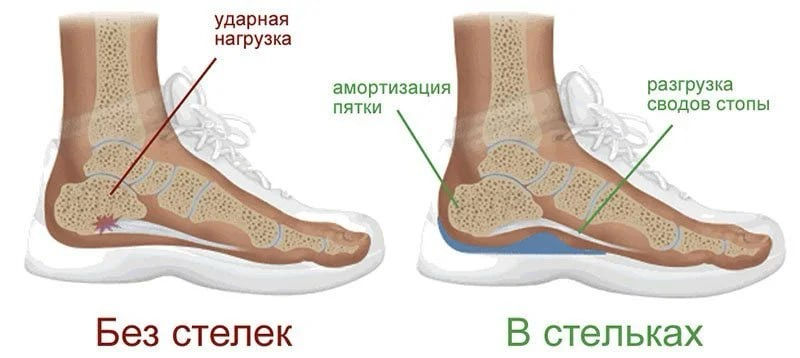 Хорошая осанка: орто-гаджеты для апгрейда стоп | Сетка — социальная сеть от hh.ru