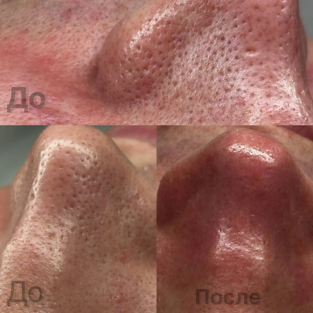 Комбинированная чистка + пилинг 🤌
Напоминаю про скидку -20%
Запись 🗓
Группа ВК: Magicface
https://vk | Сетка — социальная сеть от hh.ru