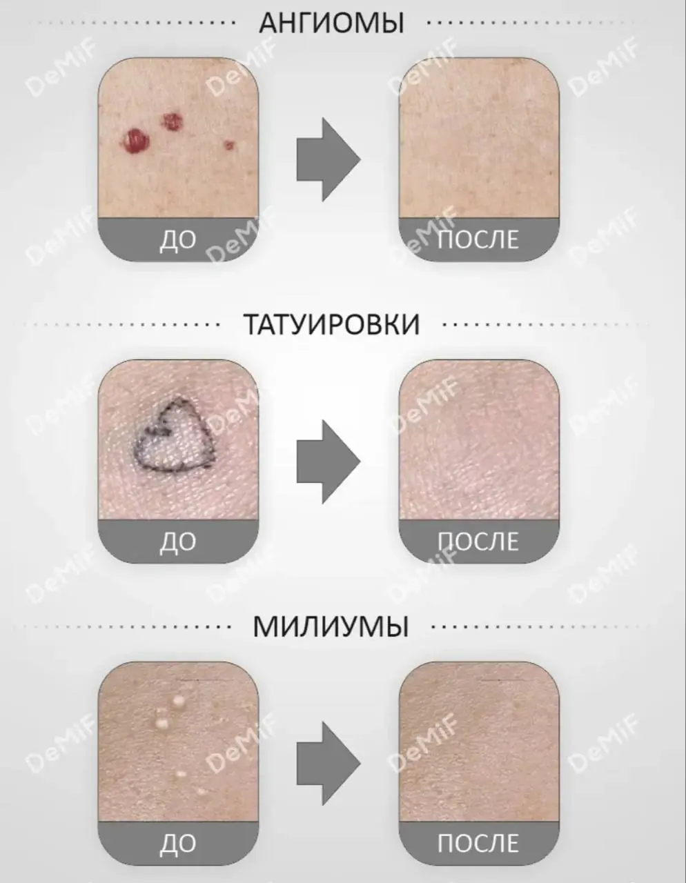 Аппарат Работает по технологии ионной карбонизации, обеспечивая точное и безопасное воздействие на кожу | Сетка — социальная сеть от hh.ru