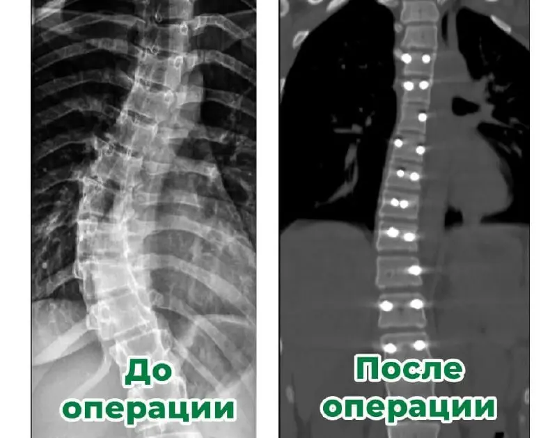 👨‍⚕️Ставропольские хирурги подарили подростку здоровое будущее
Сложный диагноз — идиопатический сколиоз с искривлением в 40 градусов — грозил 14-летней ставропольчанке не только серьезными проблемами ... | Сетка — социальная сеть от hh.ru