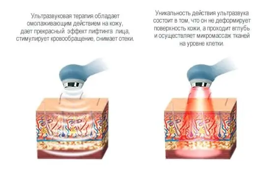 Ультразвуковой массаж лица 👍 | Сетка — социальная сеть от hh.ru