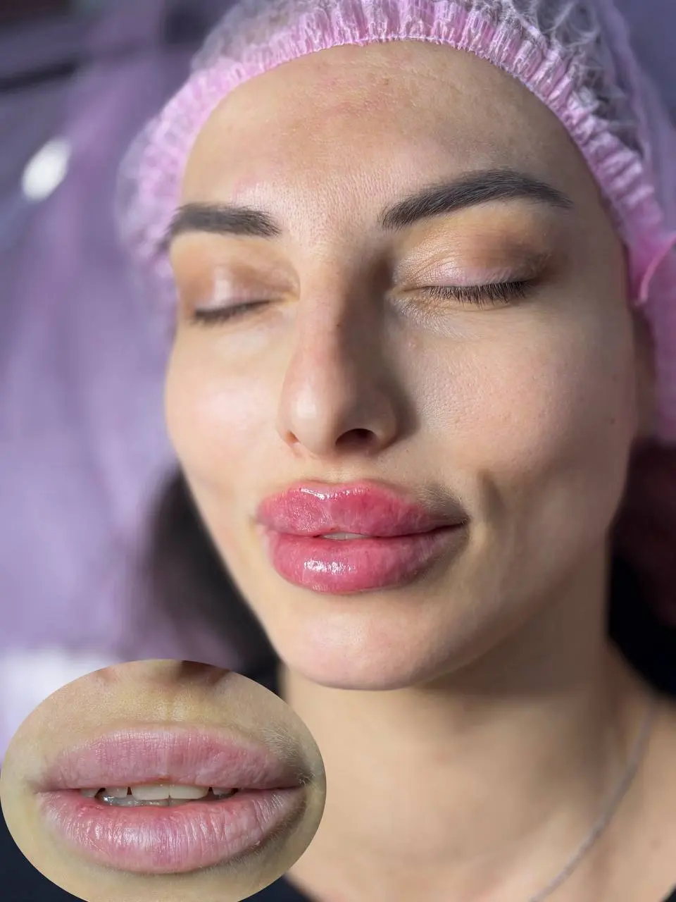 Контурная пластика губ 1,1ml
Европа - Стилаж М
Посмотрите какая красота 😻
Тел: 89179772607
What’sApp/ telegram
С любовью ваш косметолог ❤️
#мезосамара #косметолог #нити #косметологсамара #красота #губ... | Сетка — социальная сеть от hh.ru