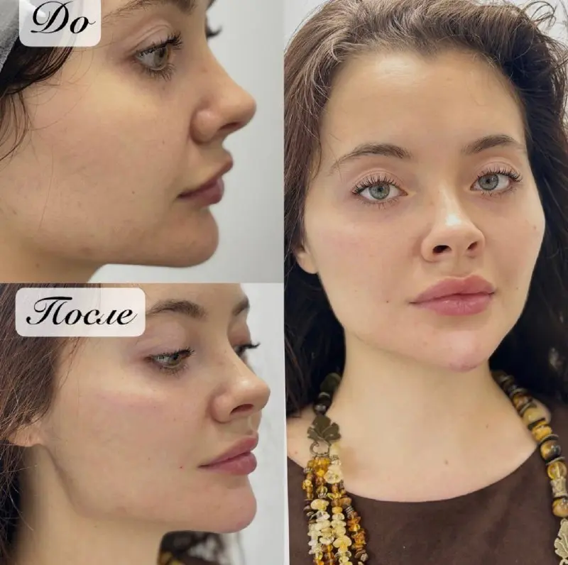 Full face
Выполнена коррекция:
✨ нижней третьи лица ( углы Джоли , подбородок )
✨ носогубная складка
✨ средняя треть лица ( скулы)
Запись веду Москва/Самара
Для записи пишите в личные сообщения | Сетка — социальная сеть от hh.ru