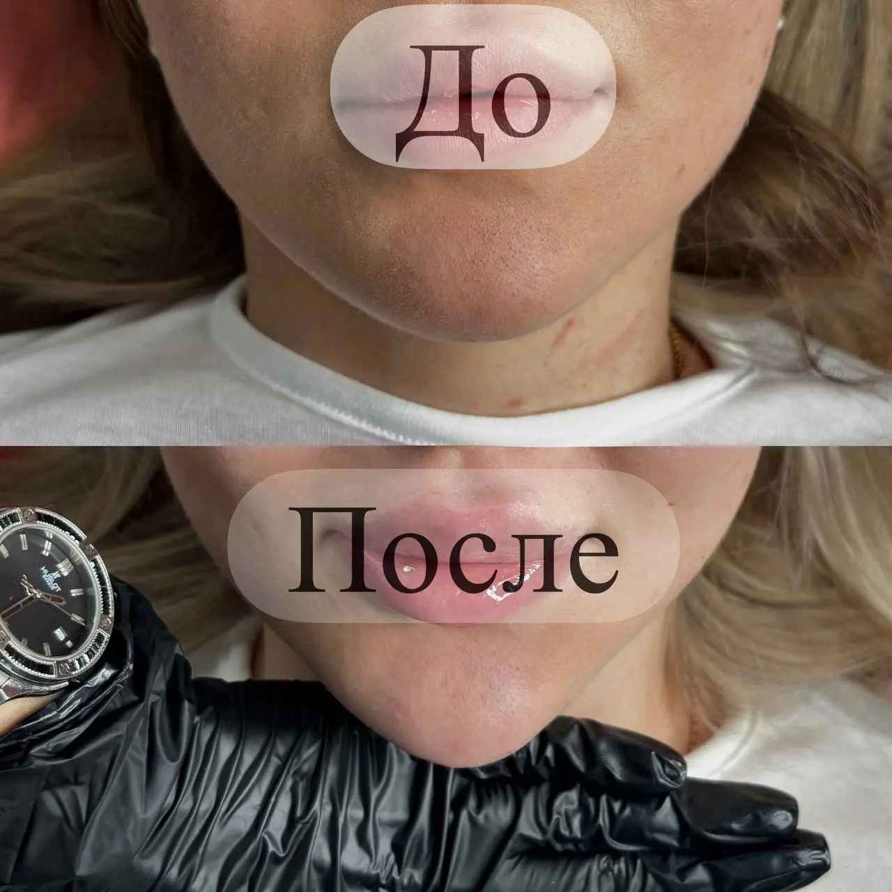 Контурная пластика нижней трети ( подбородка )
На март мест осталось мало | Сетка — социальная сеть от hh.ru