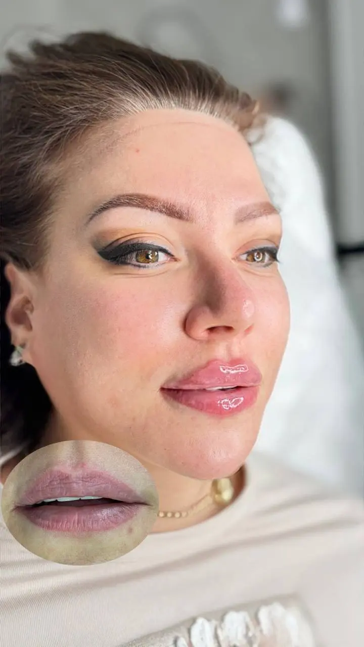 Губы после выведения , объем 2ml 💋 | Сетка — социальная сеть от hh.ru