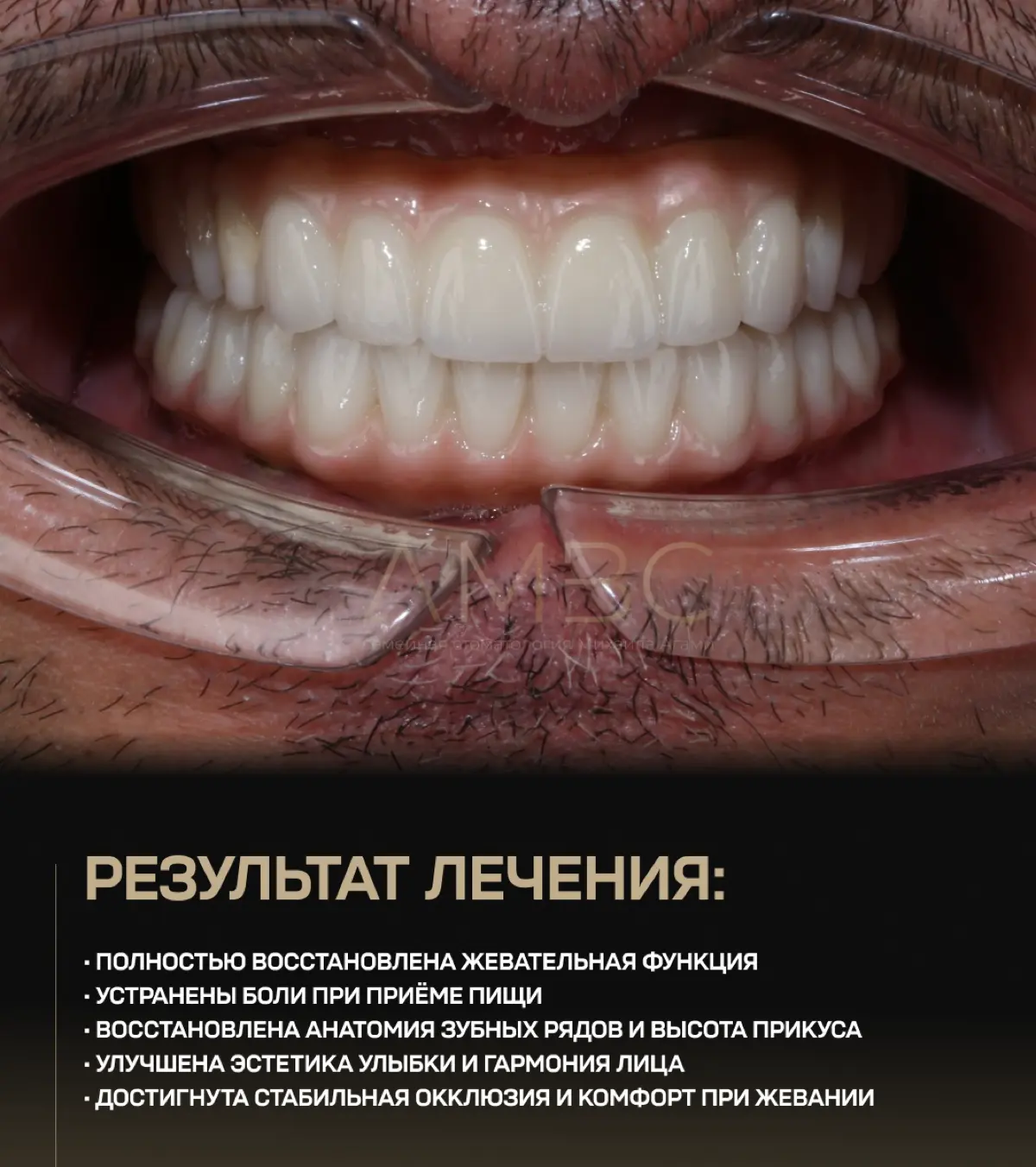 Эта история - пример того, как за один день можно решить даже очень сложную стоматологическую проблему.
Надо сделать отступление, что такое не может быть исполнено всего за 1 визит ко мне | Сетка — социальная сеть от hh.ru