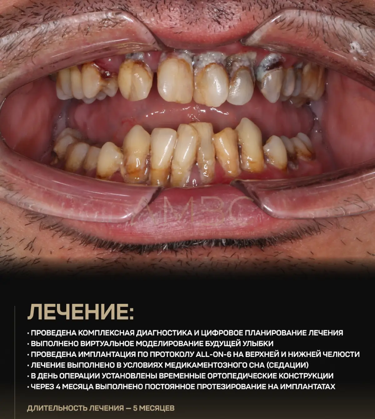 Эта история - пример того, как за один день можно решить даже очень сложную стоматологическую проблему.
Надо сделать отступление, что такое не может быть исполнено всего за 1 визит ко мне | Сетка — социальная сеть от hh.ru