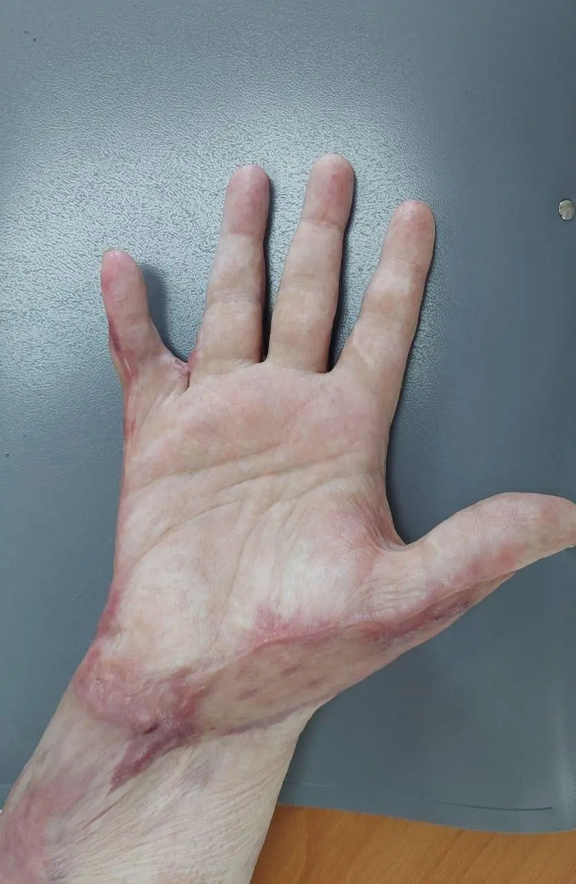 👩‍⚕️ В Пятигорске пациентке после ожога восстановили подвижность пальца
Женщина пострадала при взрыве газового баллона весной 2025 года | Сетка — социальная сеть от hh.ru