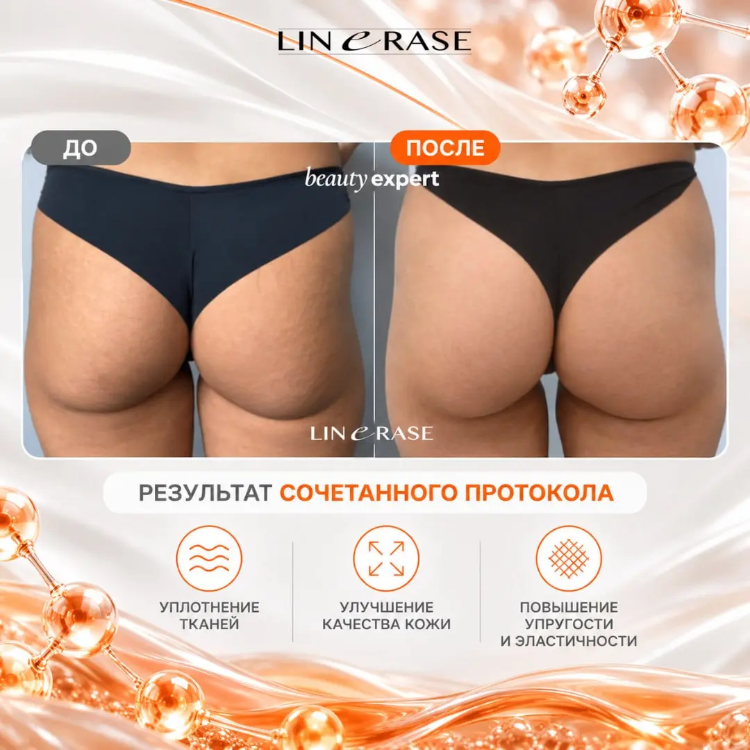 Сочетание LINERASE и нитевого лифтинга подбирает врач - с учётом показаний, противопоказаний и индивидуальных особенностей.
Подробнее о подходе рассказывает врач-косметолог Дарья Деткова | Сетка — социальная сеть от hh.ru